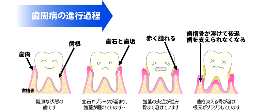 歯周病の進行過程