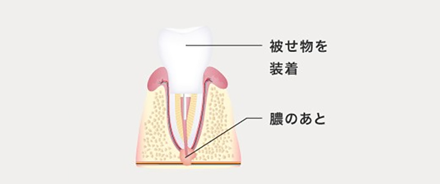 虫歯が進行して神経まで感染している