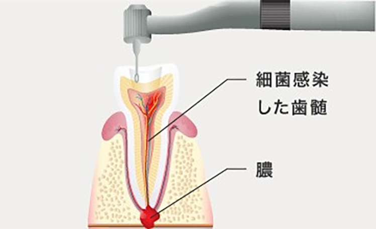 2 根管の清掃・消毒