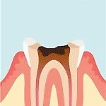 虫歯の部分を削り歯根を綺麗にします
