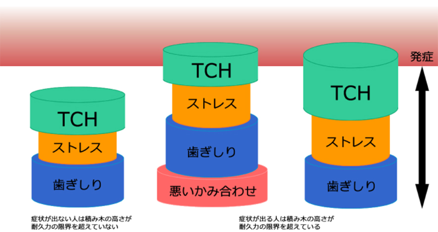 顎関節症になる原因